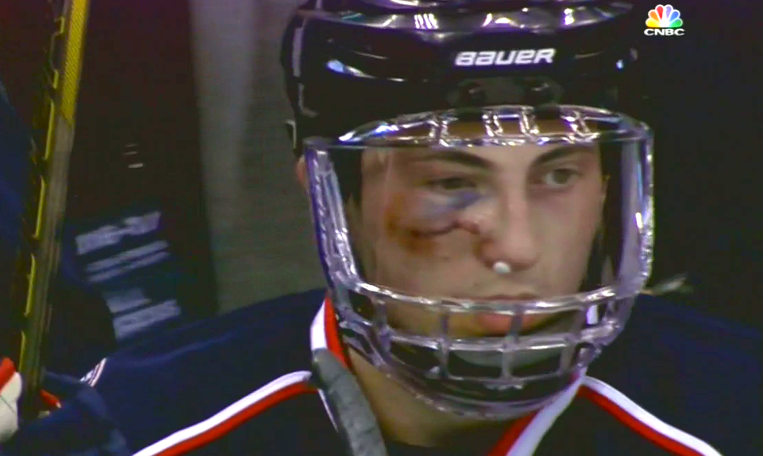 puck in the face nhl